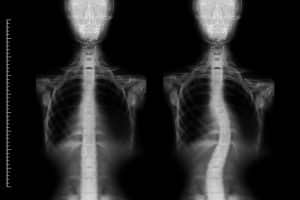 scoliosis pain relief